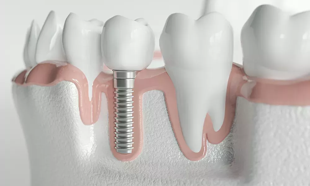 Possible side effects of dental implants